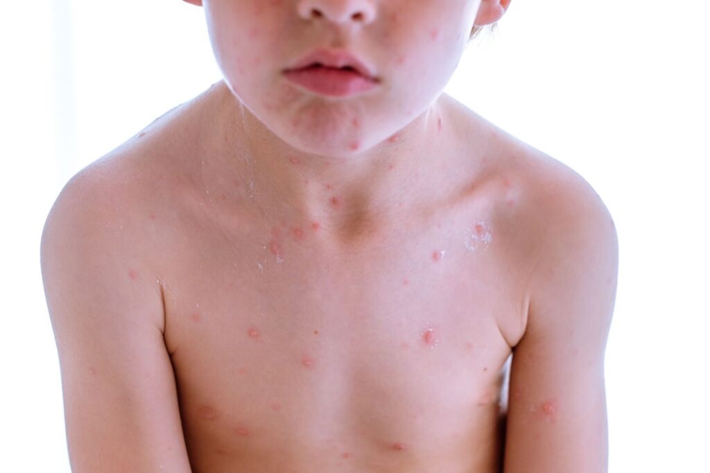 7 най-често срещани кожни проблеми при децата